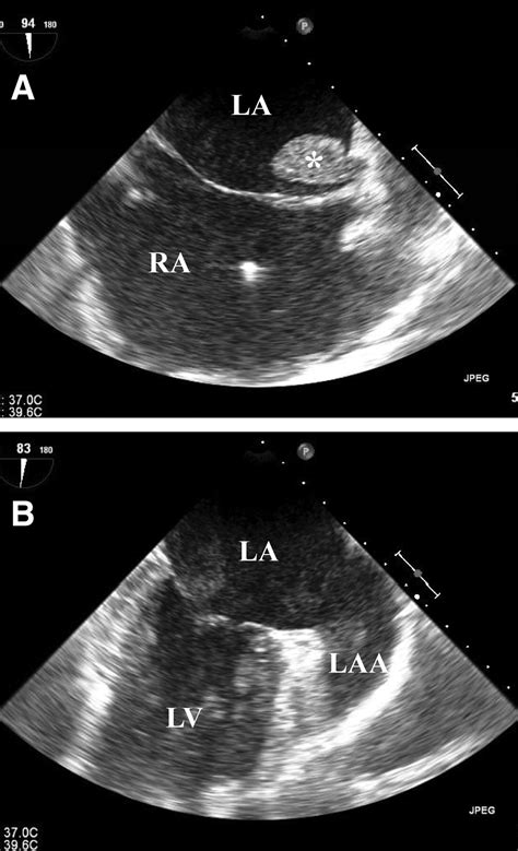 lv diverticulum|lv apical diverticulum.